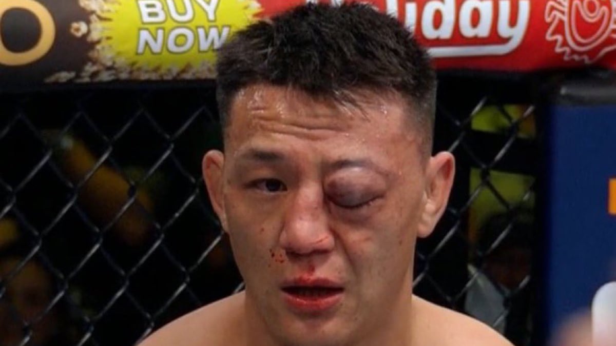 Update Provided On Gruesome Eye Injury Suffered By Rongzhu In UFC Fight Night Loss