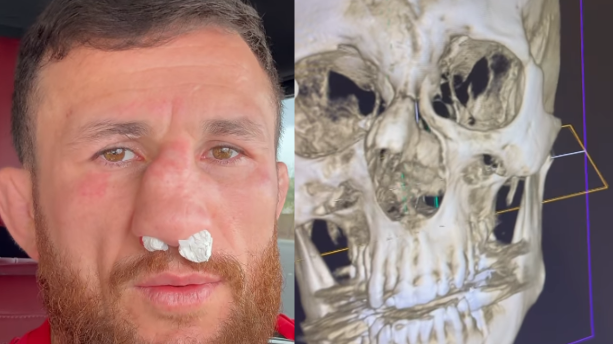 Merab Dvalishvili Rejects Surgery Despite Brutal Injury: 'My Nose Is F**ed Up'